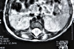 miofribromatosis-pulmonar-congenita-miofibromatosis-infantil-congenita-afectacion-viscera-unica-1997-006