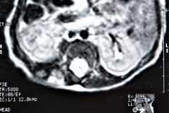 miofribromatosis-pulmonar-congenita-miofibromatosis-infantil-congenita-afectacion-viscera-unica-1997-007