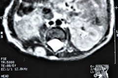miofribromatosis-pulmonar-congenita-miofibromatosis-infantil-congenita-afectacion-viscera-unica-1997-009