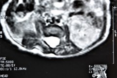 miofribromatosis-pulmonar-congenita-miofibromatosis-infantil-congenita-afectacion-viscera-unica-1997-010