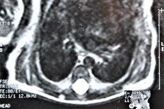 miofribromatosis-pulmonar-congenita-miofibromatosis-infantil-congenita-afectacion-viscera-unica-1997-011