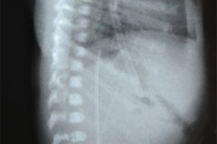 multi-invadido-tubo-endotraqueal-alto-sonda-gastrica-linea-arterial-umblical-cateter-venoso-femoral-izq-2003-000