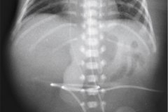 multi-invadido-tubo-endotraqueal-alto-sonda-gastrica-linea-arterial-umblical-cateter-venoso-femoral-izq-2003-001