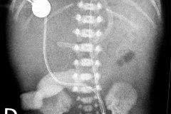 munon-umbilical-cateter-art-umbilical-2004-000