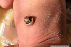 munon-umbilical-y-descamacion-piel-evolucion-natural-2009-000
