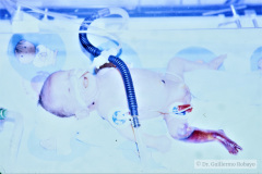 necrosis-pierna-der-diabetes-gestacional-emh-1987-006