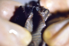 necrosis-subglotica-post-ventilacion-mecanica-prolongada-patologia-1990-000