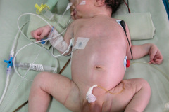 neonato-multinvadido-tubos-torax-endotraqueal-sondas-nasogastrica-vesical-monitore-000