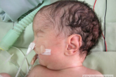 neonato-multinvadido-tubos-torax-endotraqueal-sondas-nasogastrica-vesical-monitore-001