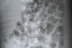 neumatosis-intestinal-ecn-iia-1988-05-12-000