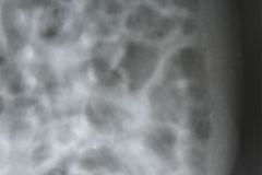 neumatosis-intestinal-ecn-iia-1988-05-12-002