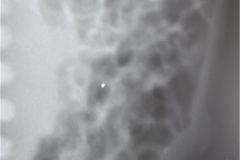 neumatosis-intestinal-ecn-iia-1988-05-12-003