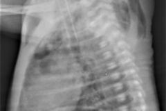 neumomediastino-enfisema-subcutaneo-neumoperitoneo-002