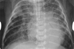 neumonia-multilobar-nosocomial-2004-000