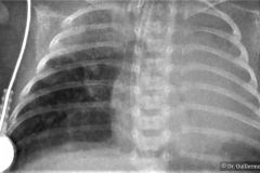 neumonia-multilobar-nosocomial-2004-001