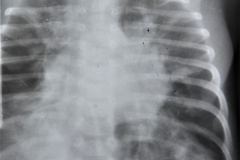 neumonia-sepsis-ileo-1986-003