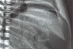 neumoperitoneo-1993-001