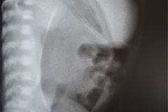 neumoperitoneo-cateter-ven-femoral-der-1999-001