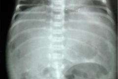 neumoperitoneo-niveles-hidroaereos-2010-001