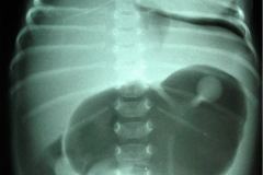 neumoperitoneo-sonda-gastrostomia-balon-inflado-1999-001