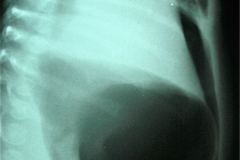 neumoperitoneo-sonda-gastrostomia-balon-inflado-1999-003