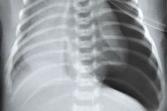 neumotorax-a-tension-tubo-torax-tubo-endotraqueal-alto-cateter-femoral-1996-000