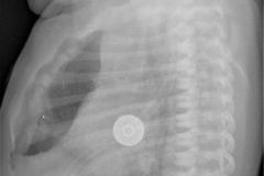 Neumotorax anterior retroesternal 2007 – Dr. Guillermo Robayo