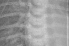 neumotorax-anterior-retroesternal-2007-001