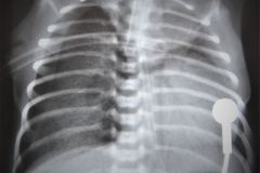 neumotorax-desviacion-mediastino-izq-tubo-torax-2003-000