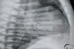 neumotorax-neumomediastino-post-denitrogenizacion-2006-003