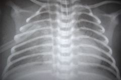 neumotorax-pre-y-post-tubo-de-torax-2003-001