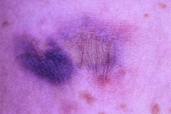 nevus-epidermico-de-spilus-sobre-nevus-001