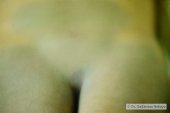 nevus-melanocitico-dermico-mancha-mongolica-gluteo-tipico-001