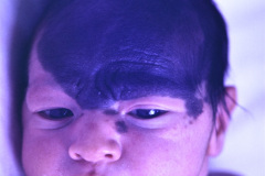 nevus-melanocitico-gigante-craneal-dolicocefalia-1990-000
