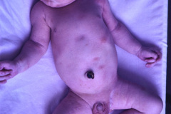 nevus-melanocitico-gigante-craneal-dolicocefalia-1990-002