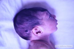 nevus-melanocitico-gigante-craneal-dolicocefalia-1990-004
