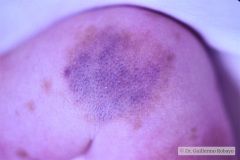 nevus-melanocitico-gigante-craneal-dolicocefalia-1990-006