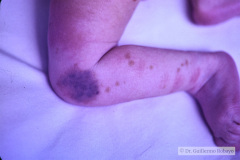 nevus-melanocitico-gigante-craneal-dolicocefalia-1990-008