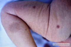 nevus-melanocitico-gigante-cuero-cabelludo-000