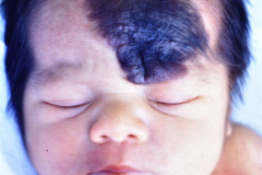 nevus-melanocitico-gigante-cuero-cabelludo-005