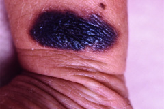 nevus-melanocitico-gigante-lunar-lombosacro-1990-001