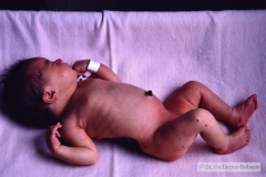 nevus-melanocitico-gigante-lunar-lombosacro-1990-007