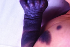 nevus-melanocitico-gigante-mano-y-brazo-izq-1989-002