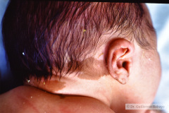 nevus-melanocitico-mediano-cafe-en-leche-cuello-1987-000