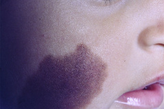 nevus-melanocitico-mediano-cara-000