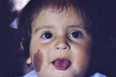 nevus-melanocitico-mediano-cara-001