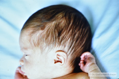 nevus-melanocitico-pequeno-cafe-cuero-cabelludo-001