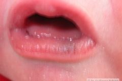 nevus-melanocitico-pequeno-labios-2005-002