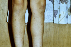 nevus-melanocitico-pequeno-000
