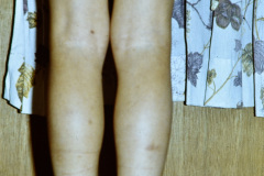 nevus-melanocitico-pequeno-002
